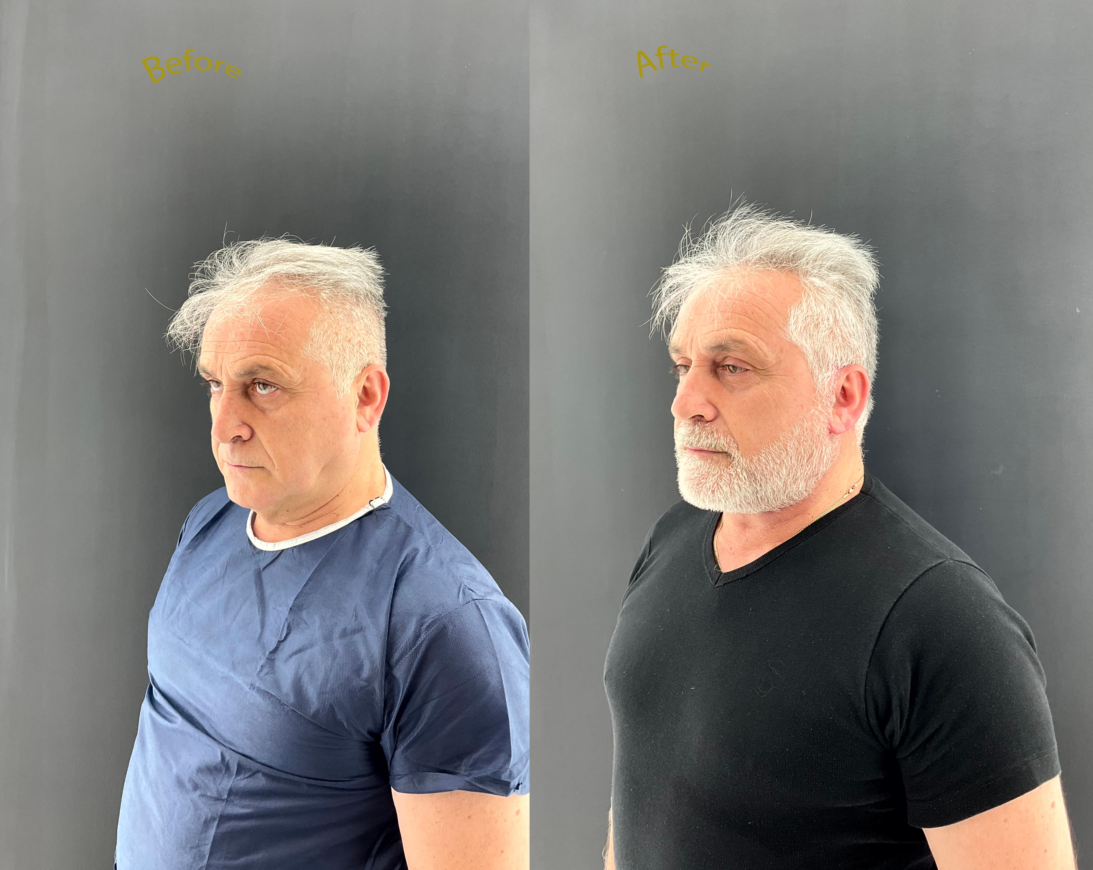 Facial surgery before and after