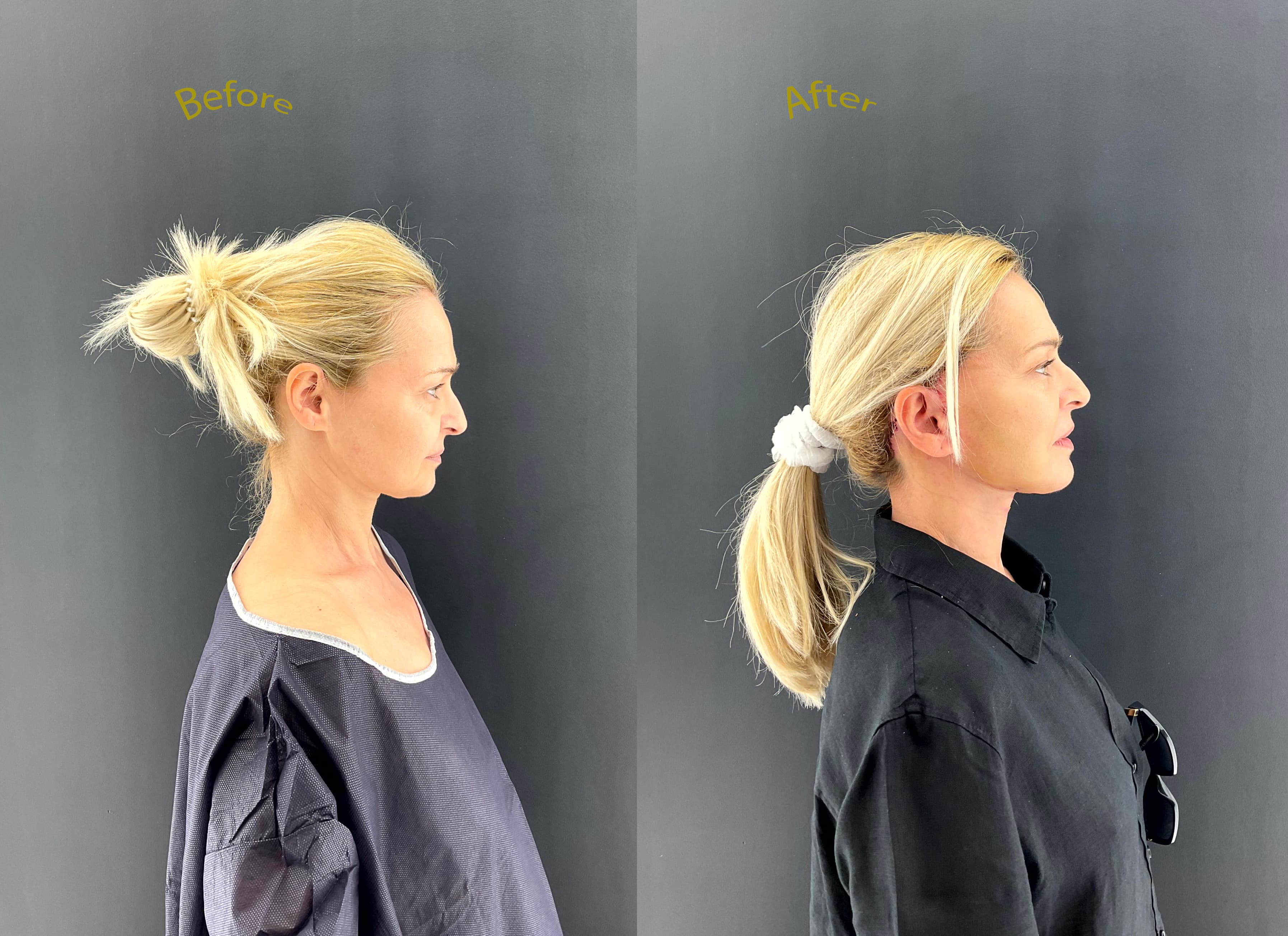 Rhinoplasty before and after