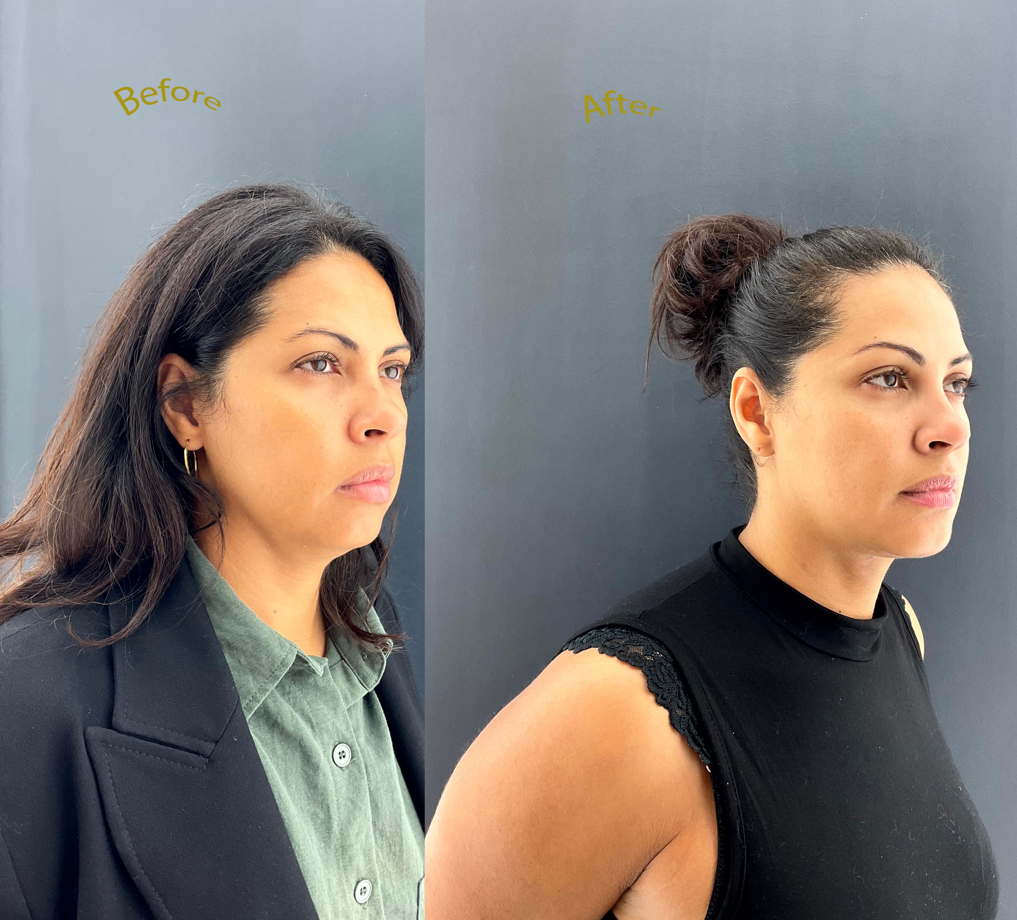 Neck lift before and after