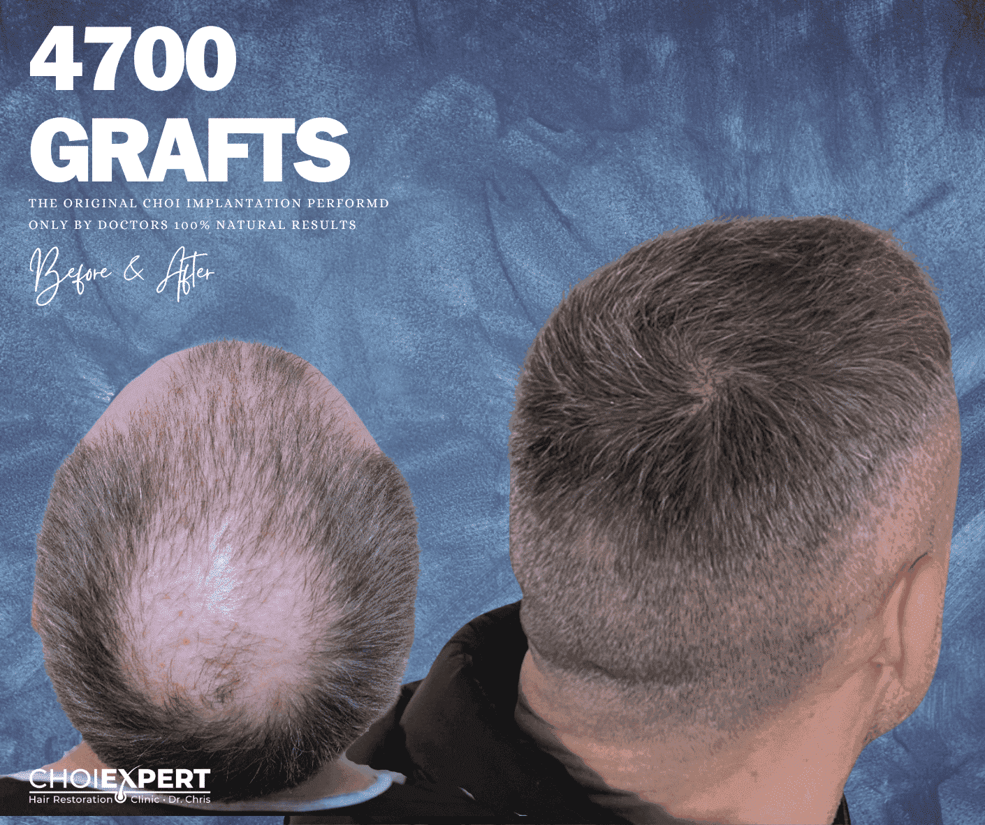 Hair transplant before and after