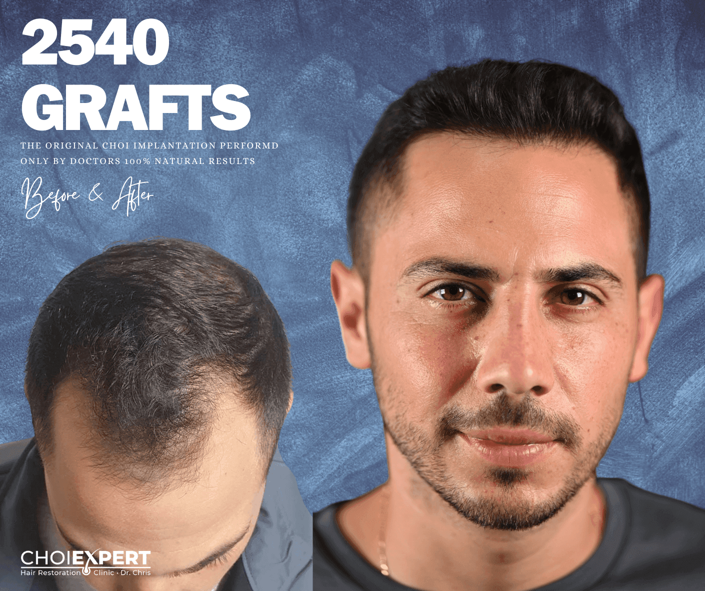 Hairline design before and after